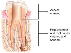 tooth illustration of cleaned and shaped root canals