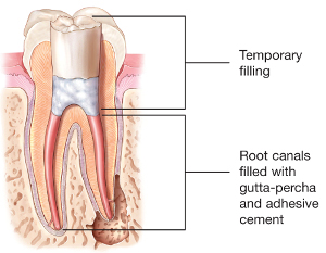 Tooth illustration with root canals filled