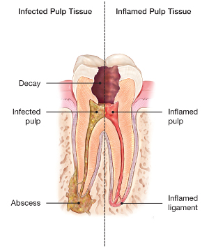 illustration of infected and inflamed pulp tissue