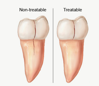 Illustration of cracked teeth, non-treatable and treatable