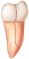 Tooth illustration of split tooth