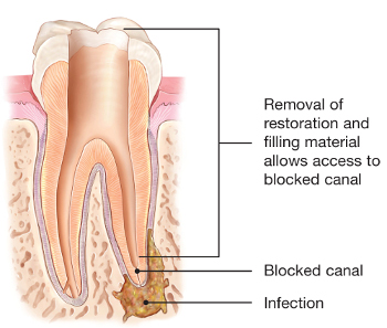 Illustration of removal of restoration and filling material for retreatment