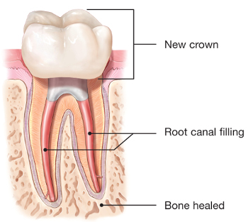 Illustration of healed retreated tooth