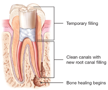 Illustration of retreated tooth with temporary filling