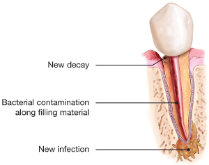 Illustration of tooth needing retreatment due to decay and infection