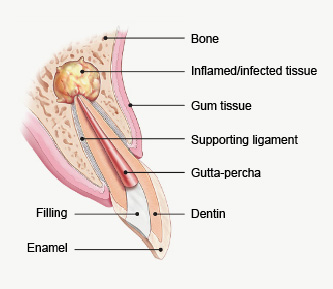 Illustration of tooth for endodontic surgery