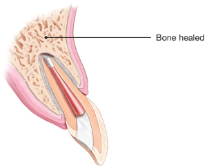 Illustration of healed tooth after endodontic surgery