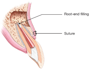 Illustration of root-end filling in endodontic surgery on tooth