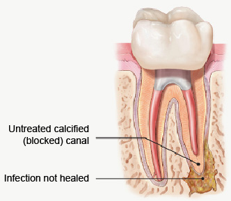 Tooth illustration of infection that has not healed