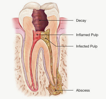 inflamed and infected tooth illustration