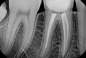 digital radiograph of tooth and roots