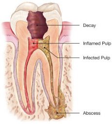 Abscessed tooth illustration