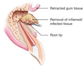 removal of inflamed / infected tissue in endodontic surgery