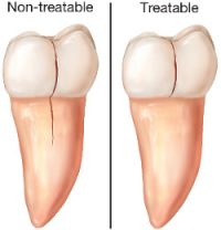 cracked teeth Illustration of cracked teeth, treatable and non-treatable