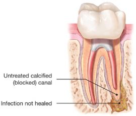 Illustration showing infected tooth root that has not healed properly